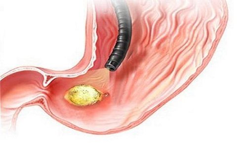 Nội soi không đau ở đâu?