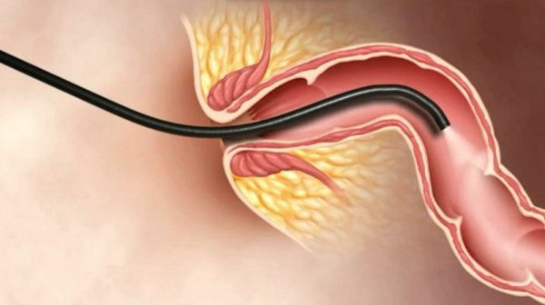 Nội soi MCU là gì, vai trò trong chẩn đoán sớm – điều trị sớm ung thư?