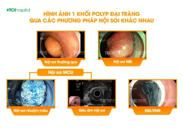 Nội soi MCU là gì, vai trò trong chẩn đoán sớm – điều trị sớm ung thư?