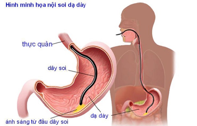 Nội soi nhiều lần có tốt không?