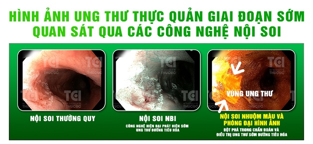 Nội soi nhuộm màu là gì và những điều cần biết 