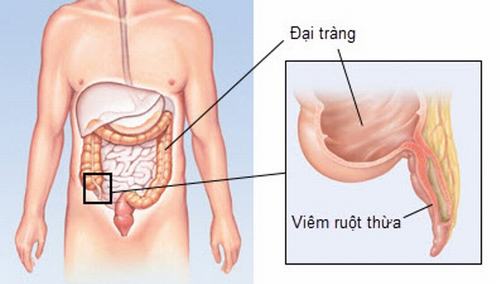 Nội soi ổ bụng có đau không? tổn thương tại vùng bụng