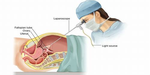 Nội soi ổ bụng tổng quát khi nào và có tác dụng gì?