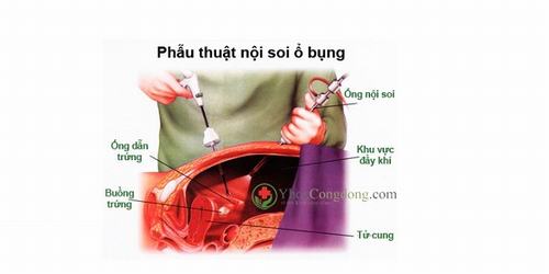 Nội soi ổ bụng tổng quát khi nào và có tác dụng gì?