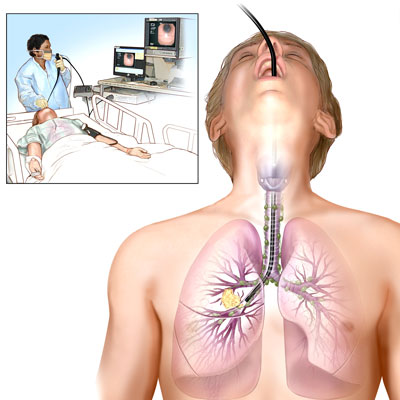 Nội soi phế quản có nguy hiểm không?