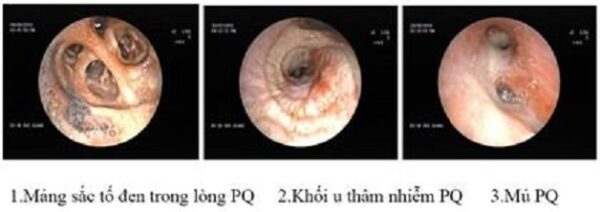 Nội soi phế quản có nguy hiểm không?