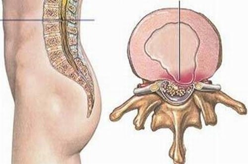 Nội soi thoát vị đĩa đệm cột sống thắt lưng cần lưu ý