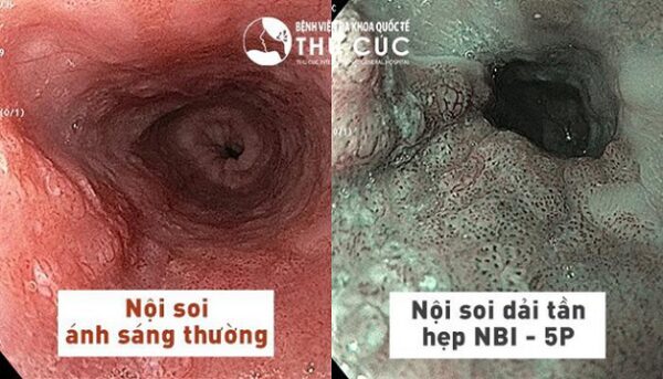 Nội soi tiêu hóa công nghệ NBI hiện đại hàng đầu hiện nay