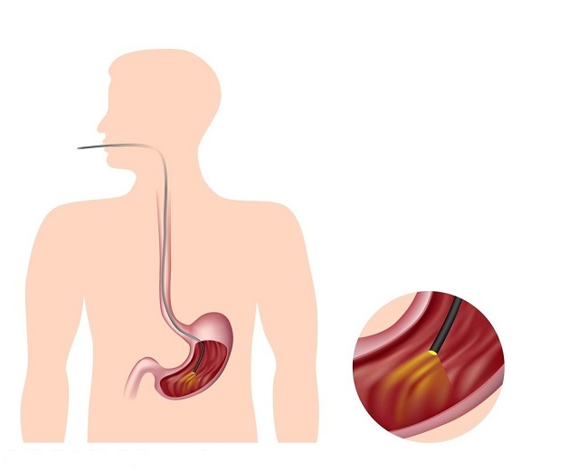 Nội soi tiêu hóa phát hiện những bệnh nào? Ai nên nội soi?