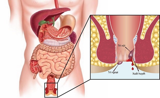 Nội soi trĩ là gì? Khi nào cần thực hiện kĩ thuật này?