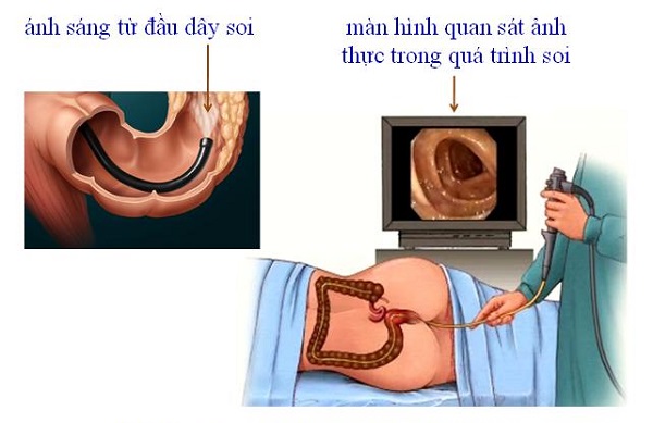 Nội soi trực tràng giá bao nhiêu?