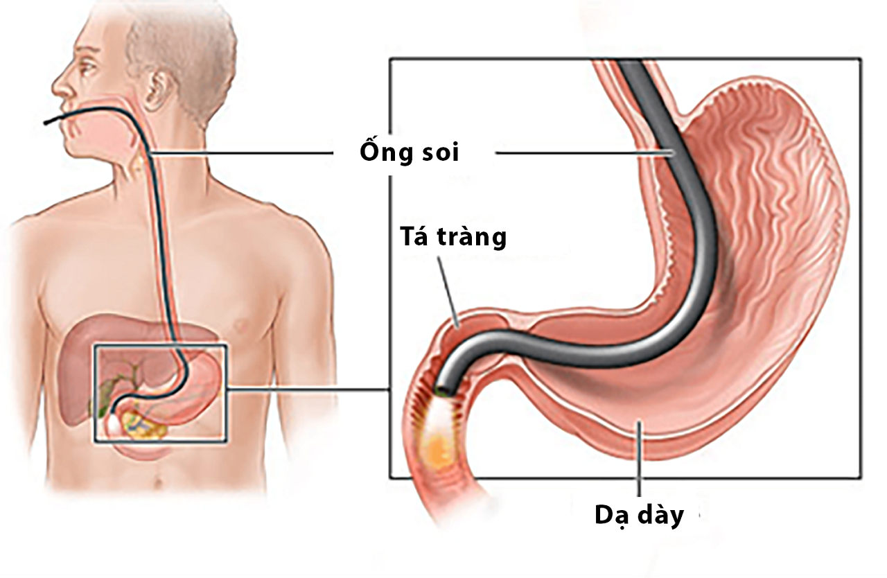 Nội soi viêm dạ dày – Phương pháp và quy trình thực hiện