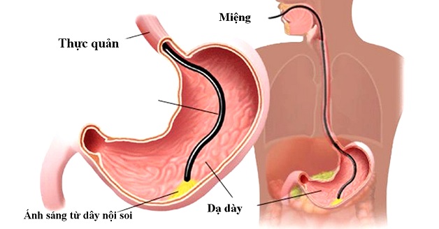 Nội soi viêm dạ dày – Phương pháp và quy trình thực hiện