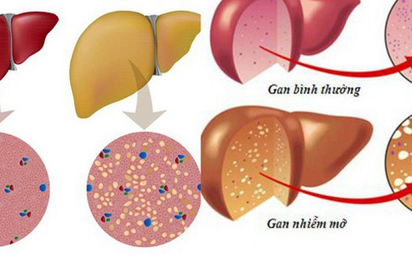 Nước uống cho người gan nhiễm mỡ