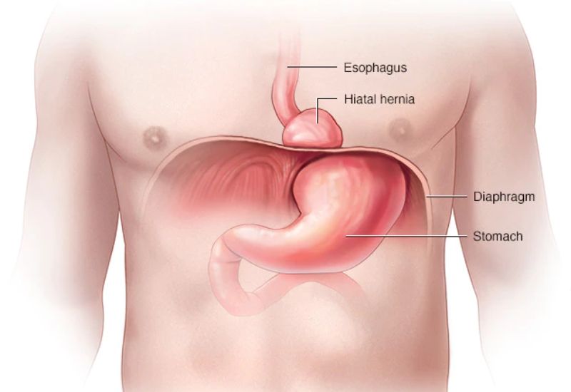 Nuốt nghẹn do trào ngược: Sự lầm tưởng cần chú ý