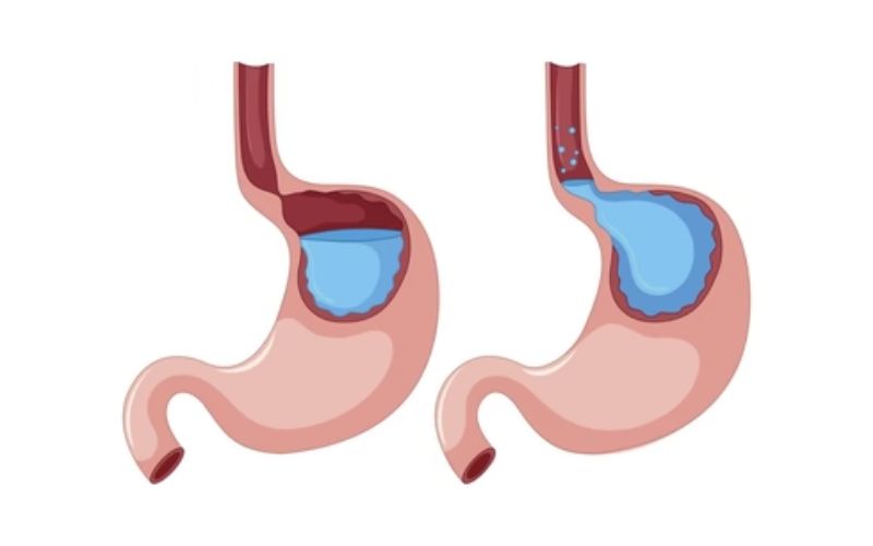 Nuốt vướng do trào ngược dạ dày hay do đâu?