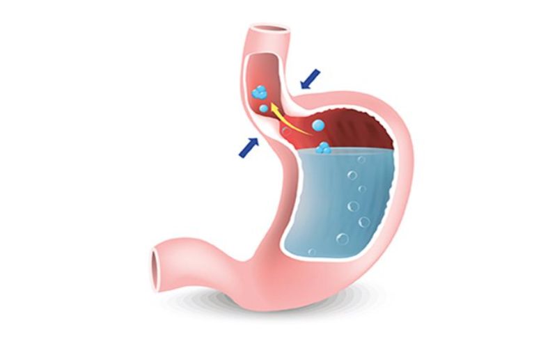 Nuốt vướng do trào ngược dạ dày hay do đâu?
