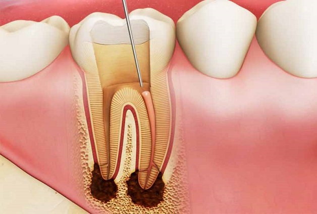 Nướu răng bị sưng nhức là dấu hiệu của bệnh gì? 