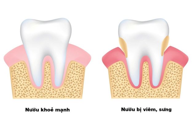 Nướu răng đỏ và những nguyên nhân khó ngờ tới