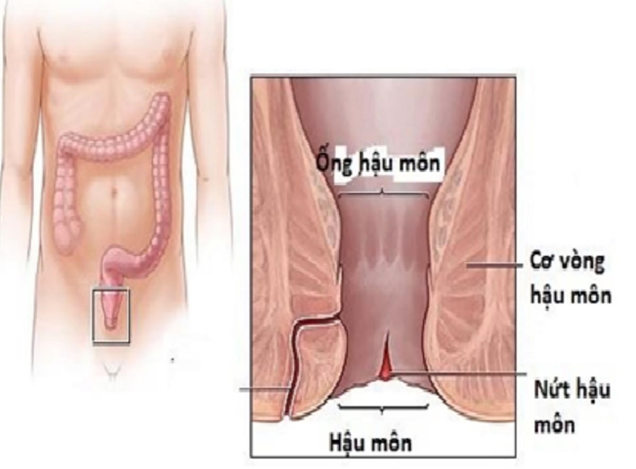 Nứt kẽ hậu môn ngâm nước muối có tốt không?