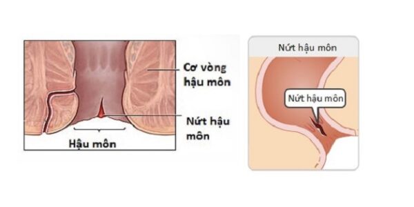 Nứt kẽ hậu môn ở trẻ nhỏ ba mẹ tuyệt đối đừng bỏ qua