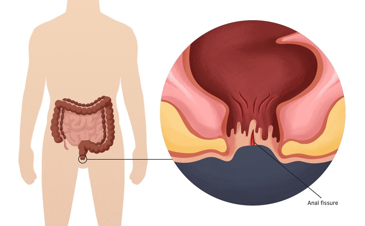 Nứt kẽ hậu môn tự lành được không? Giải pháp điều trị?