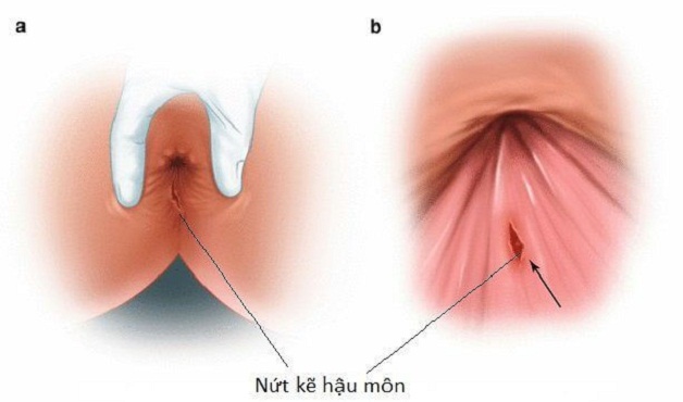 Nứt kẽ hậu môn tự lành được không? Giải pháp điều trị?