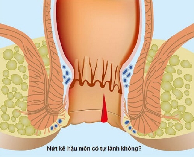 Nứt kẽ hậu môn tự lành được không? Giải pháp điều trị?