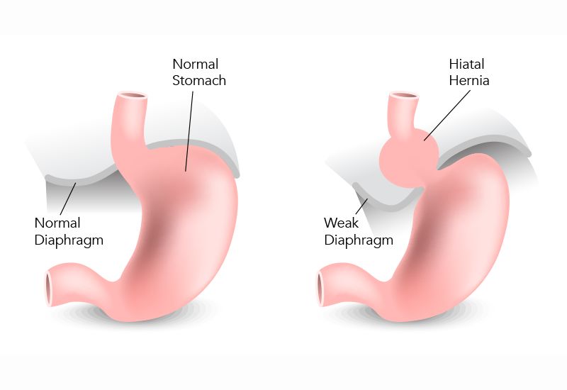 Ợ nóng sau khi ăn có phải là dấu hiệu của bệnh lý tiêu hóa