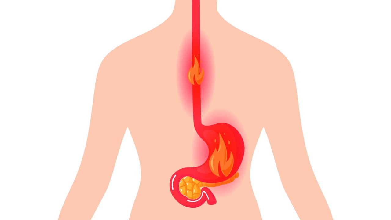 Ợ nóng xuất phát từ các bệnh lý cần cẩn trọng