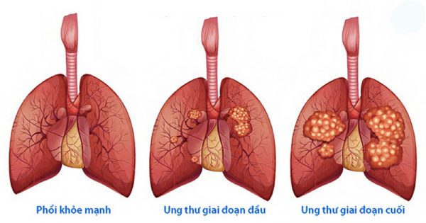 Phác đồ điều trị ung thư phổi: Những điều đáng chú ý