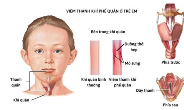 Phác đồ điều trị viêm thanh khí phế quản ở trẻ em 