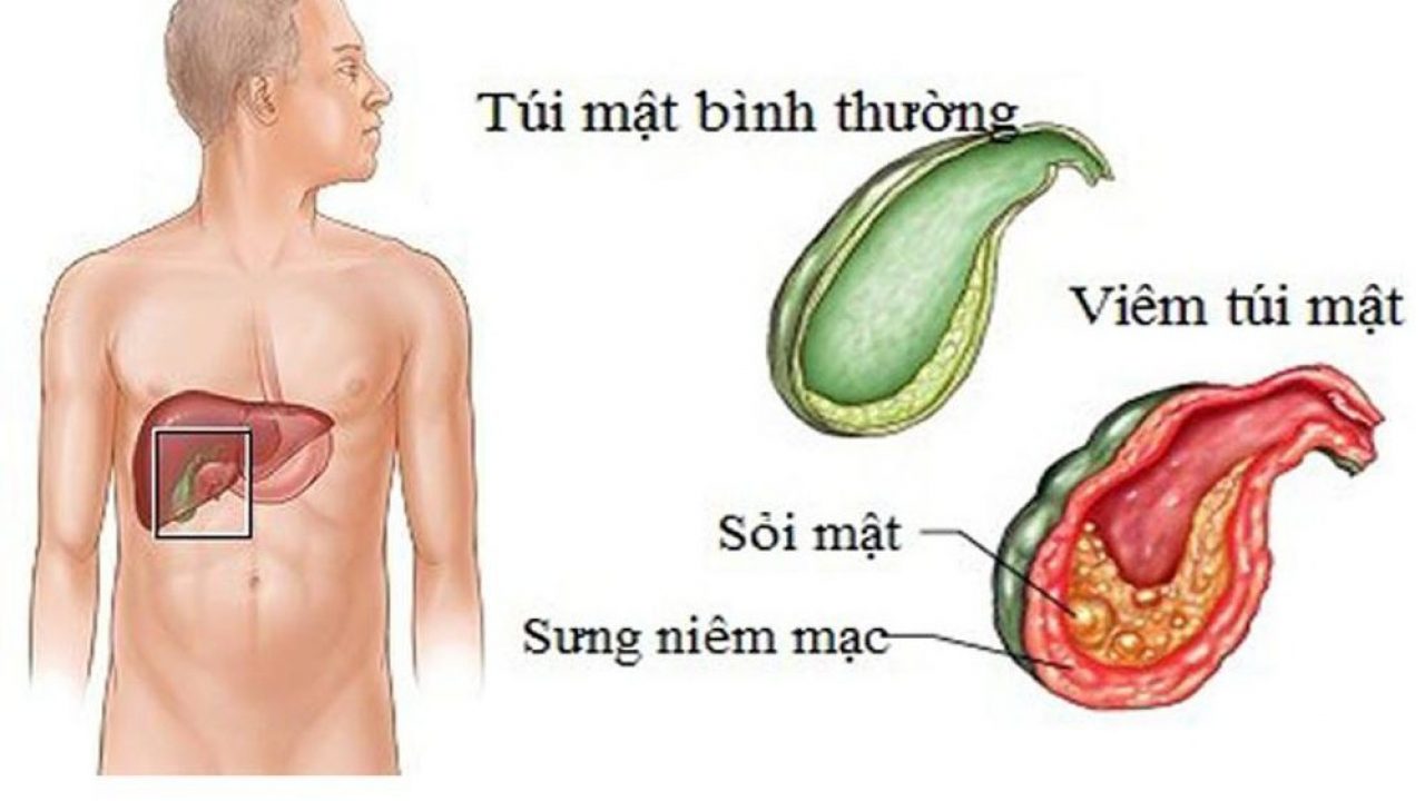 Phác đồ điều trị viêm túi mật bạn cần biết