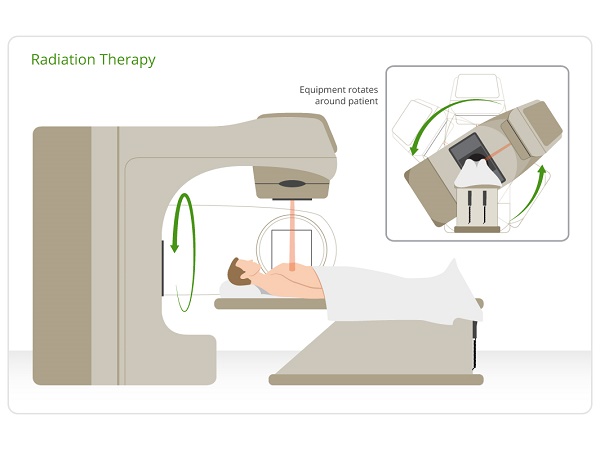 Phác đồ xạ trị ung thư phổi