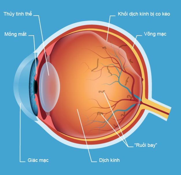 Phân biệt các bệnh lý dịch kính võng mạc