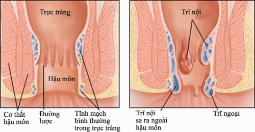 Phân biệt các dạng bệnh trĩ