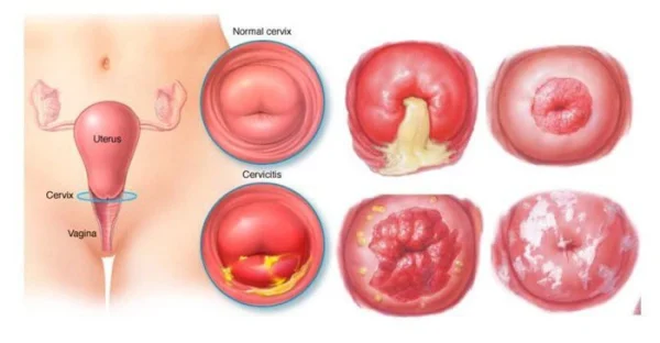 Phân biệt các giai đoạn của ung thư cổ tử cung