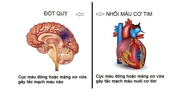 Phân biệt đột quỵ và nhồi máu cơ tim