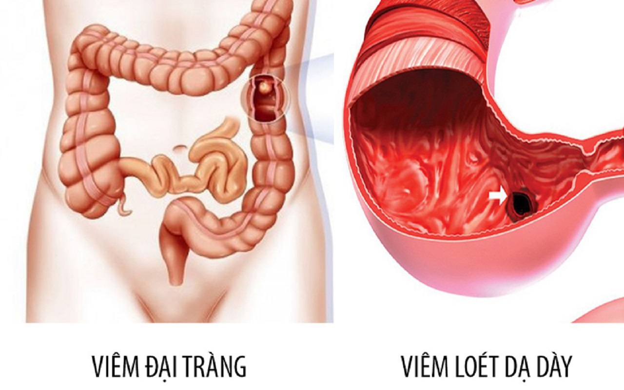 Phân biệt giữa đau dạ dày và đại tràng