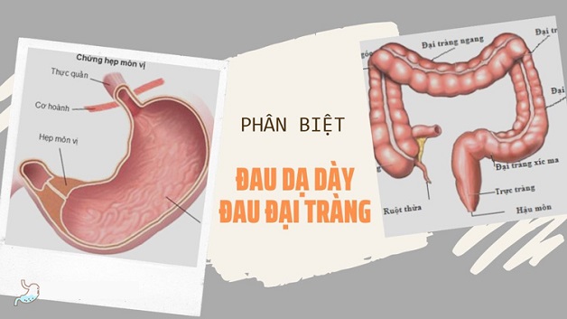 Phân biệt giữa đau dạ dày và đại tràng