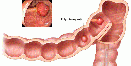 Phân biệt giữa u đại tràng lành tính và ác tính