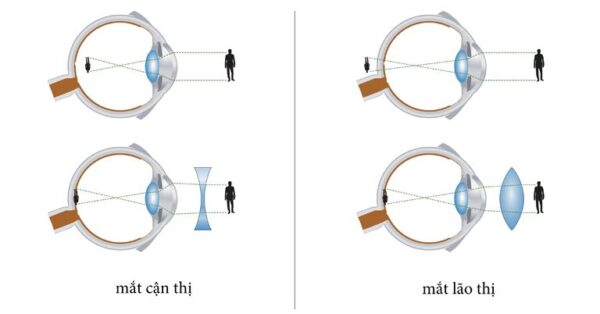 Phân biệt hai tật khúc xạ cận thị và lão thị