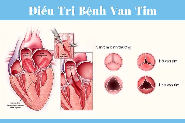 Phân biệt hở và hẹp van tim cùng cách điều trị, phòng ngừa