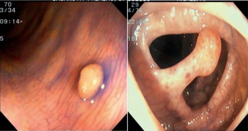 Phân biệt polyp trực tràng không cuống và có cuống