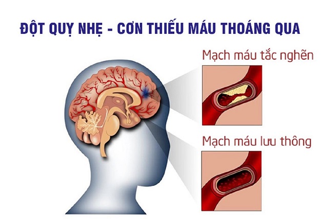 Phân biệt rối loạn tiền đình và thiếu máu não