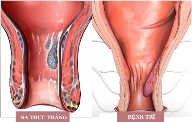 Phân biệt sa trực tràng và trĩ – Đâu là cách điều trị hiệu quả?