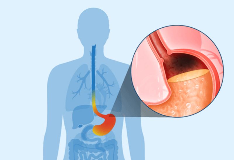 Phân biệt trào ngược dạ dày đau thượng vị và đau do tim