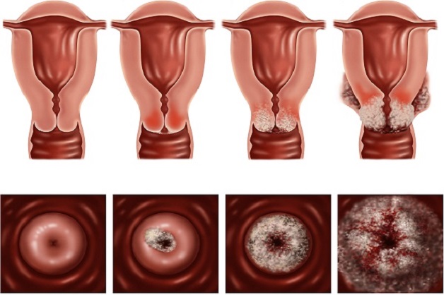 Phân biệt triệu chứng ung thư buồng trứng và cổ tử cung