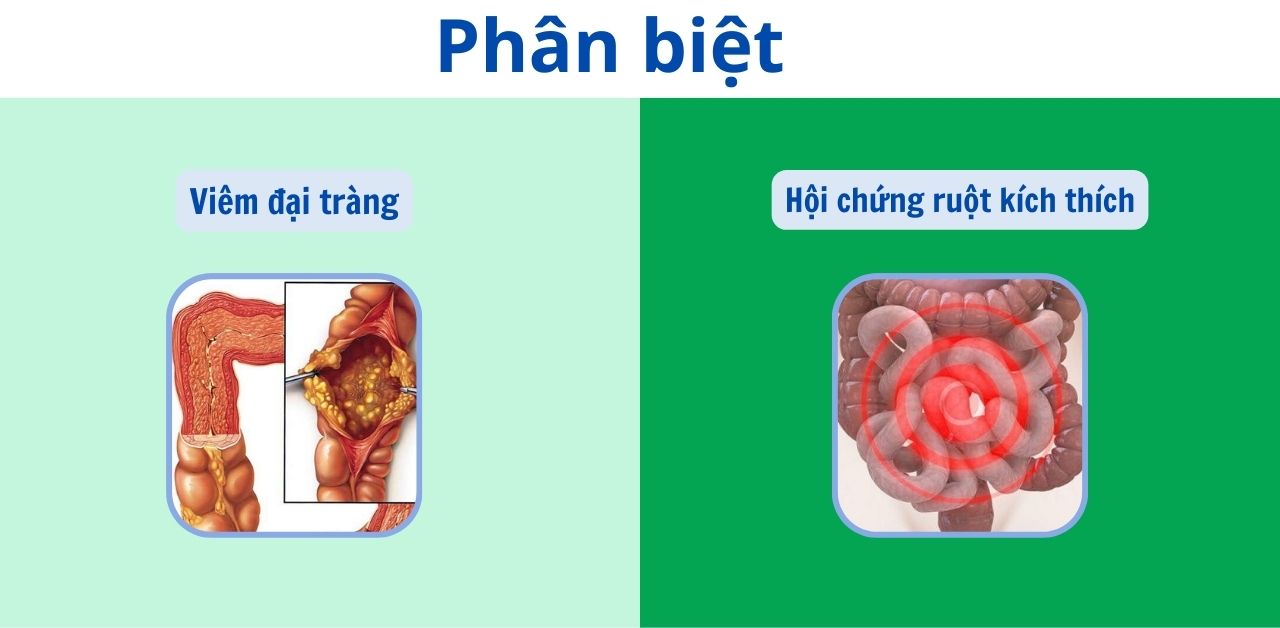 Phân biệt viêm đại tràng và hội chứng ruột kích thích