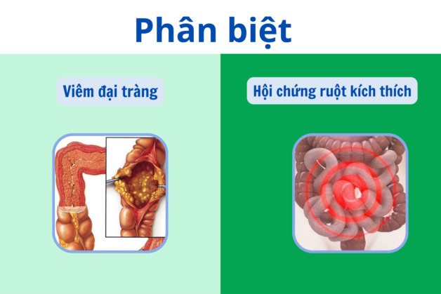 Phân biệt viêm đại tràng và hội chứng ruột kích thích